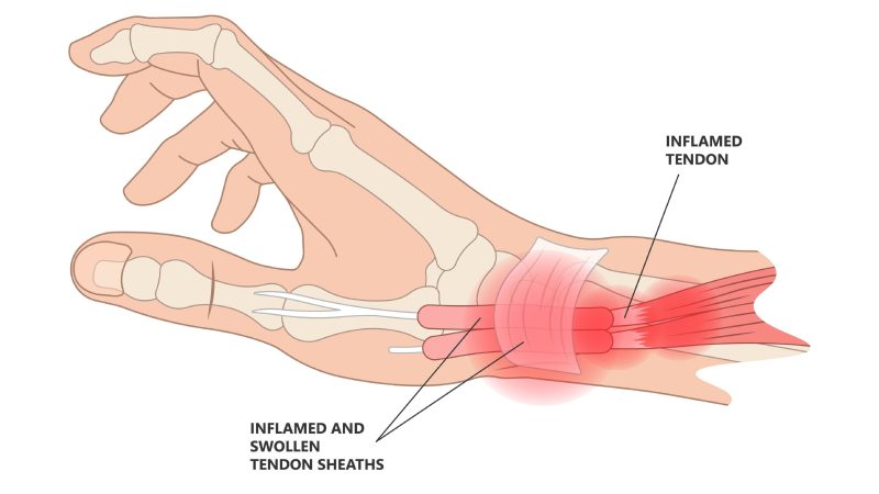 De+Quervain’s+Tenosynovitis+Pain+in+Base+of+Thumb