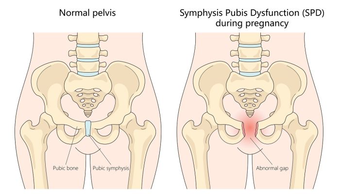 Symphysis Pubis Dysfunction during pregnancy