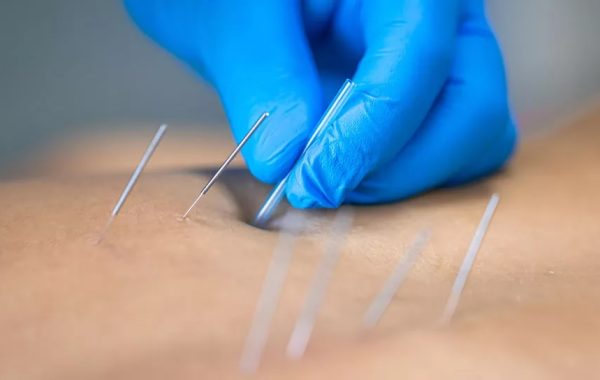 dry needling dry needling