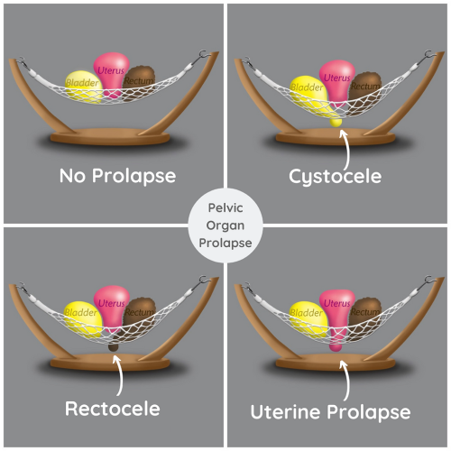 types of prolapse