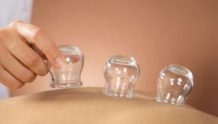 Cupping Therapy Jersey City